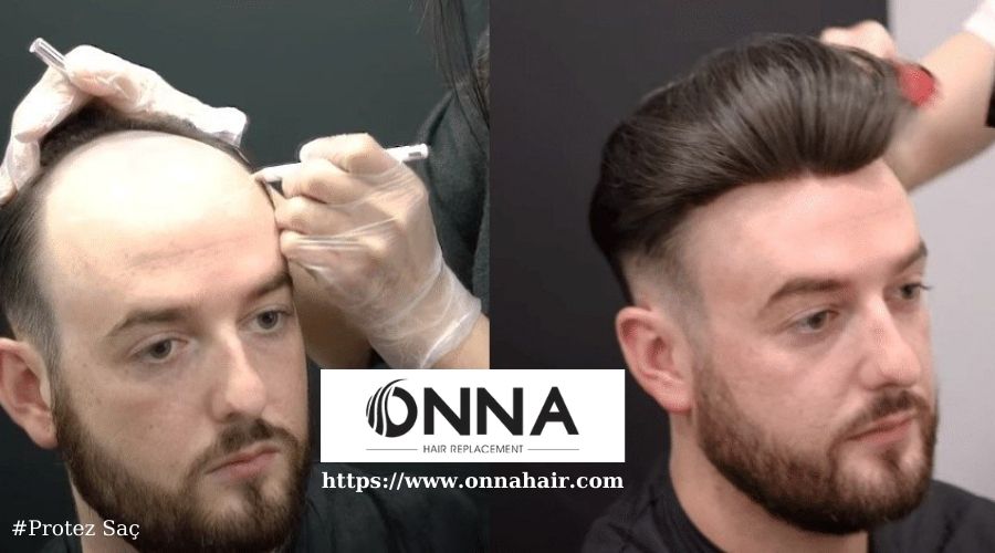 Protez Saç