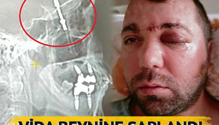 İmplant tedavisinde vida beynine saplandı… Doktorlar gözlerine inanamadı! “Bana hayatımı kaybedebileceğimi söylediler” Ameliyatı, Amerika’da dergilere konu oldu