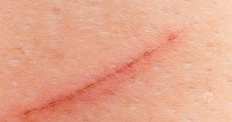 Yüz ve ciltteki çivilerin izlerini nasıl izlersiniz Tırnakların izlerinin üstesinden nasıl gelinir