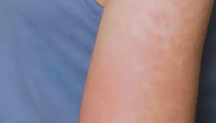 Vakalar arttı: Kırmızı alarm! Teksas’ta sonra Kansas’ta da kızamık yayılıyor