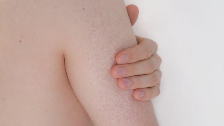 Vücutta Kırmızı Lekeler Neden Olur? Vücuttaki Kırmızı Lekeler noktalar Nasıl Geçer?