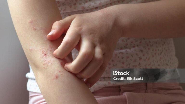 Süt Alerjisi Belirtileri Nelerdir? Süt Alerjisi Nasıl Anlaşılır? Tedavi Yöntemleri Nelerdir?